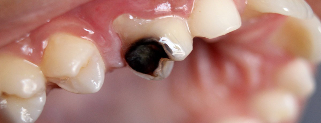 Tooth Decay Close-up image revealing the details of dental caries